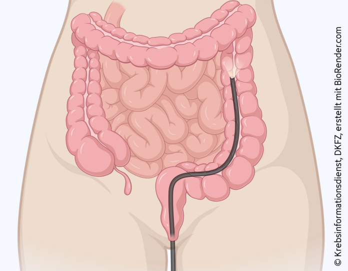 Sigmoidoskopie, © Krebsinformationsdienst, DKFZ; erstellt mit BioRender.com grafische Darstellung der Sigmoidoskopie