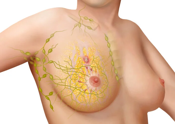 Lymphsystem und Lymphknoten bei Brustkrebs, © Frank Geisler, MediDesign Graphische Darstellung einer weiblichen Brust mit Lymphsystem und Lymphknoten