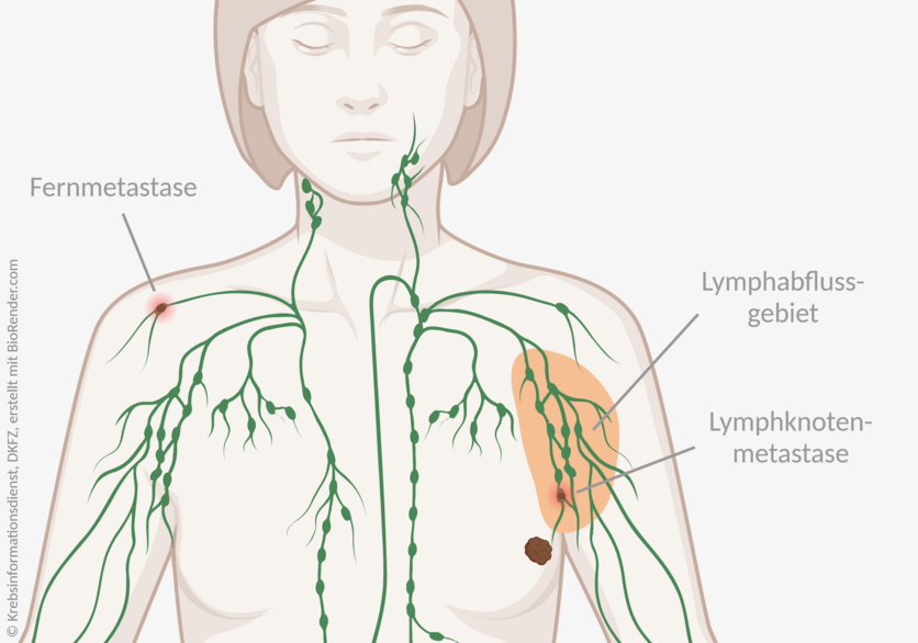 Infografik eines weiblichen Oberkörpers mit einem Tumor in der linken Brust. Das Lymphabflussgebiet ist markiert, darin ist eine Lymphknotenmetastase eingezeichnet. In der entfernten, rechten Schulter ist eine Fernmetastase in einem Lymphknoten dargestellt.