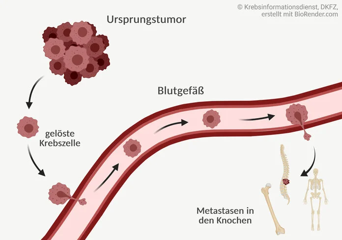Knochenmetastasen, © Krebsinformationsdienst, DKFZ; erstellt mit BioRender.com Graphische Darstellung zur Entstehung von Knochenmetastasen: Tumorzellen lösen sich vom Ursprungstumor ab, wandern in die Blutgefäße und von dort in die Knochen.