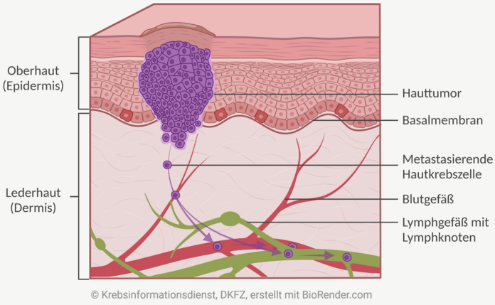 Grafische Darstellung der Haut im Querschnitt. Abgebildet und beschriftet sind die Oberhaut (Epidermis) mit den verschiedenen Schichten Lederhaut (Dermis) und die Unterhaut (Subcutis) mit Lymph- und Blutgefäßen. In der Oberhaut ist ein Hauttumor abgebildet, von dem sich einzelne Krebszellen gelöst haben und das Blut-und Lymphgefäß erreicht haben.