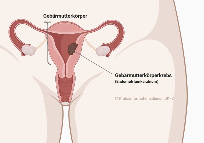 Schematische Darstellung der weiblichen Geschlechtsorgane mit Tumor im Gebärmutterkörper.