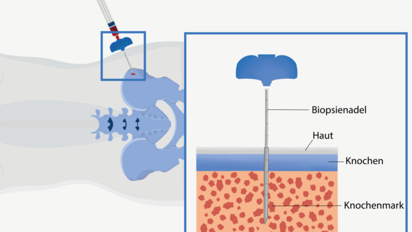 Bei der Knochenmarkuntersuchung wirde eine Biopsienadel durch die Haut in den Beckenknochen gestochen und das Knochenmark angesaugt.