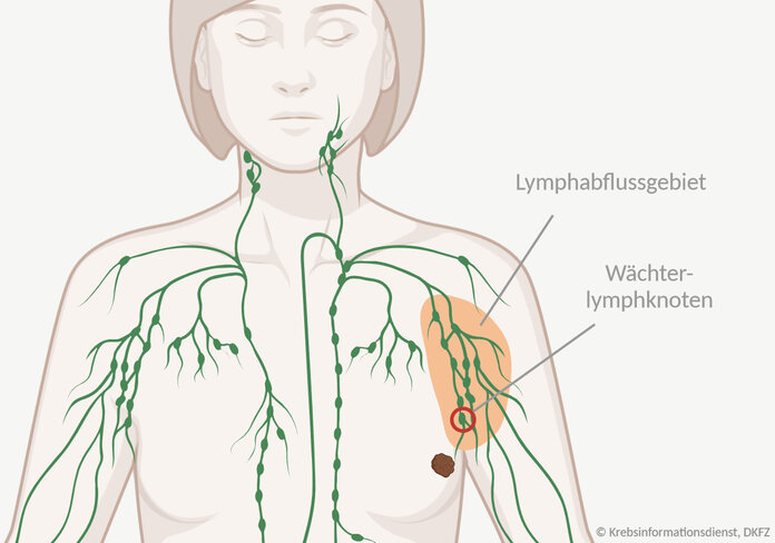Infografik, die einen weiblichen Oberkörper mit einem Tumor in der linken Brust zeigt; das Gebiet, in das die Gewebsflüssigkeit des Tumors abfließt, ist markiert und der Wächterlymphknoten ist umkreist.
