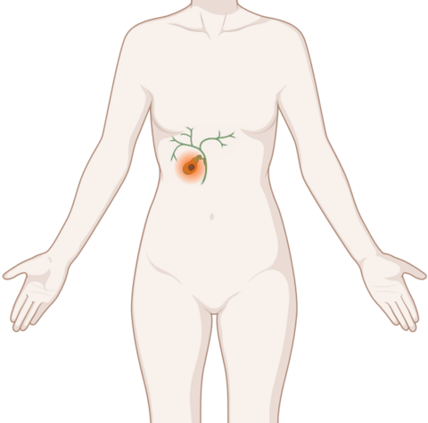 Krebs der Gallenwege, © Krebsinformationsdienst, DKFZ, erstellt mit BioRender.com Schematische, anatomische Darstellung der Gallenblase und Gallengänge mit leuchtendem Tumor