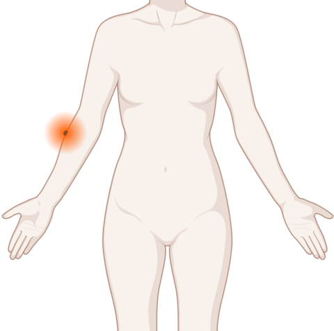 Hautkrebs, © Krebsinformationsdienst, DKFZ; erstellt mit Biorender.com Schematische, anatomische Darstellung der Haut mit leuchtendem Tumor