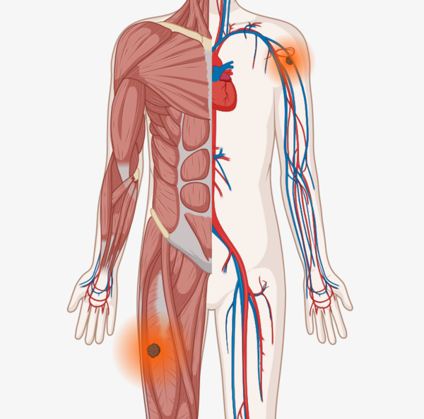 Schematische, anatomische Darstellung des Körpers mit leuchtenden Tumoren im Oberarm und im Oberschenkel