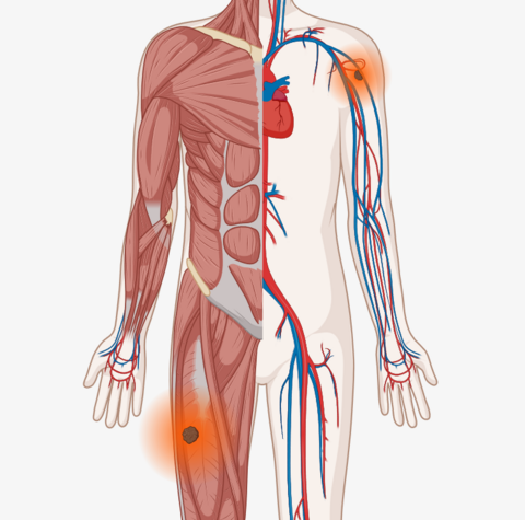 Schematische, anatomische Darstellung des Körpers mit leuchtenden Tumoren im Oberarm und im Oberschenkel