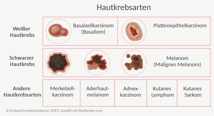 Übersicht der Krebserkrankungen, die zu Hautkrebs zählen. Zum weißen und schwarzen Hautkrebs sind repräsentative grafische Darstellungen der Tumore abgebildet.