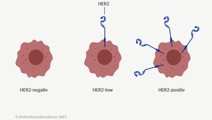 Brustkrebszellen mit keinem, wenig und viel HER2 auf der Zelloberfläche. Die Krebszelle mit wenig HER2 wird als HER2-low bezeichnet.