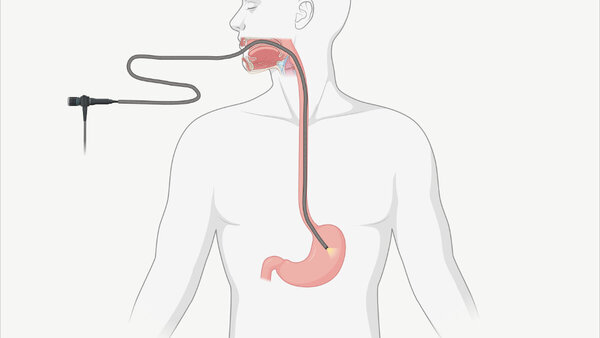 Schematische Darstellung, wie der Schlauch bei einer Magenspiegelung durch die Speiseröhre bis in den Magen verläuft.