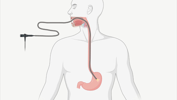 Schematische Darstellung, wie der Schlauch bei einer Magenspiegelung durch die Speiseröhre bis in den Magen verläuft.