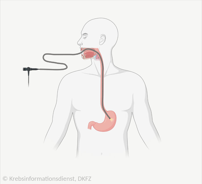 Schematische Darstellung, wie der Schlauch bei einer Magenspiegelung durch die Speiseröhre bis in den Magen verläuft.