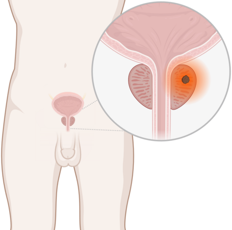 Schematische, anatomische Darstellung der Prostata mit leuchtendem Tumor