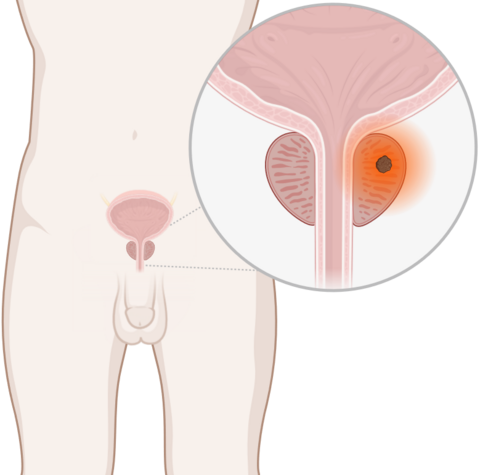 Schematische, anatomische Darstellung der Prostata mit leuchtendem Tumor