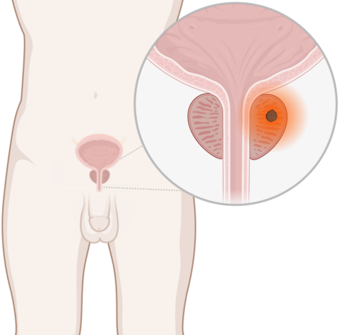 Schematische, anatomische Darstellung der Prostata mit leuchtendem Tumor