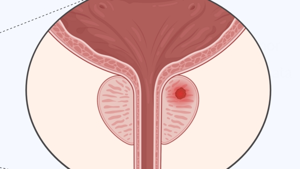 Prostatakrebs, © Krebsinformationsdienst, DKFZ; erstellt mit BioRender.com Grafische Darstellung der Lage der Geschlechtsorgane, Harnblase, Harnröhre. In der Prostata befindet sich ein Tumor (rot).