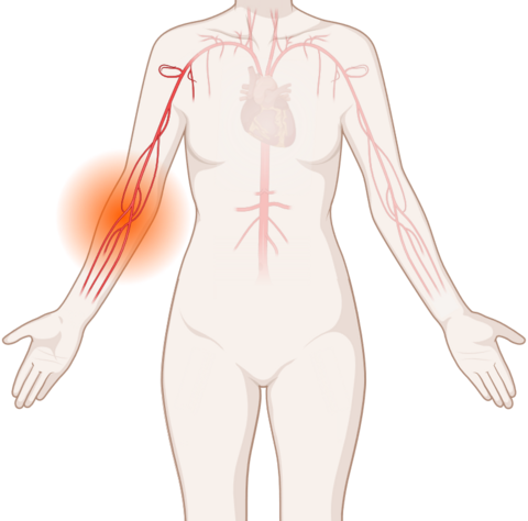 Schematische, anatomische Darstellung von Blutgefäßen mit leuchtendem Tumor.