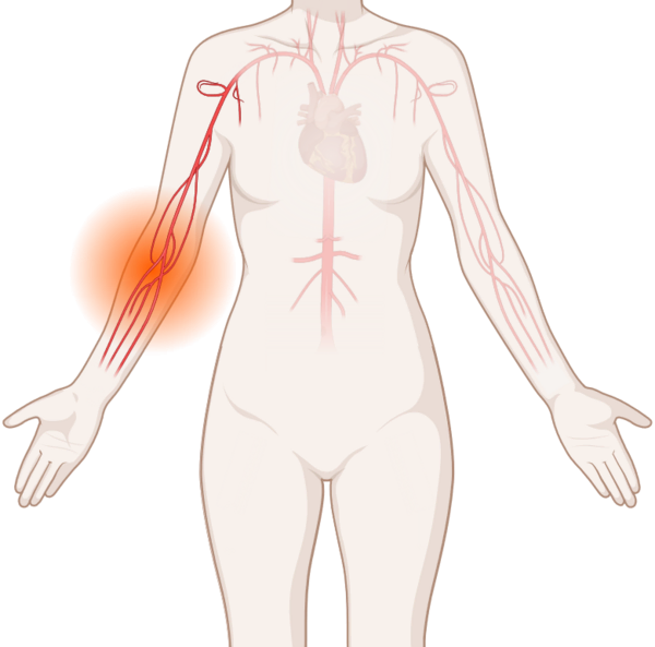 Leukämien, © Krebsinformationsdienst, DKFZ; erstellt mit BioRender.com Schematische, anatomische Darstellung von Blutgefäßen mit leuchtendem Tumor.