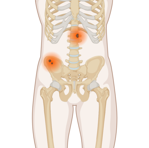 Schematische, anatomische Darstellung des Körpers mit leuchtenden Tumoren an Wirbelsäule und Beckenknochen.