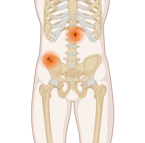 Knochenmetastasen, © Krebsinformationsdienst, DKFZ; erstellt mit BioRender.com Schematische, anatomische Darstellung des Körpers mit leuchtenden Tumoren an Wirbelsäule und Beckenknochen.