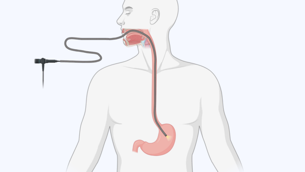 Magenspiegelung, © Krebsinformationsdienst, DKFZ; erstellt mit BioRender.com Schematische Darstellung, wie der Schlauch bei einer Magenspiegelung durch die Speiseröhre bis in den Magen verläuft.