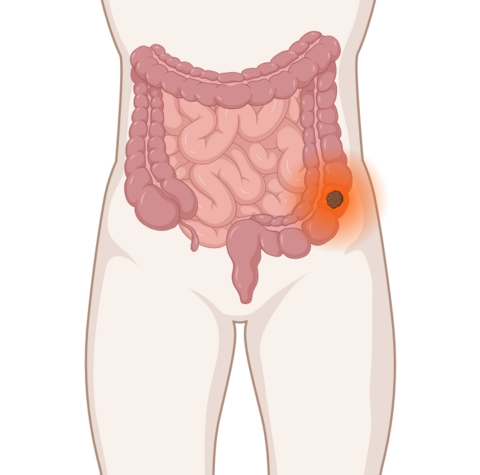 Darmkrebs, © Krebsinformationsdienst, DKFZ; erstellt mit BioRender.com Darmkrebs: anatomische Darstellung mit leuchtendem Tumor