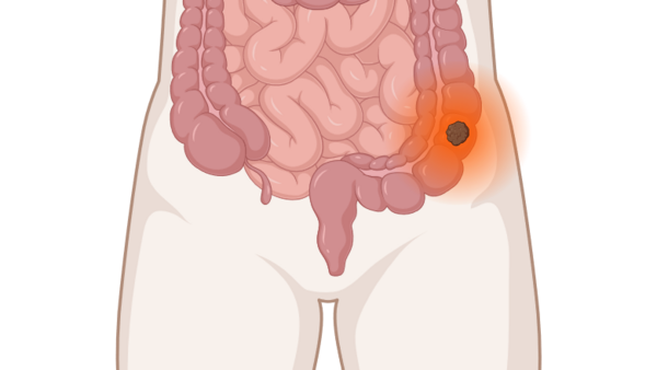 Darmkrebs, © Krebsinformationsdienst, DKFZ; erstellt mit BioRender.com Darmkrebs: anatomische Darstellung mit leuchtendem Tumor
