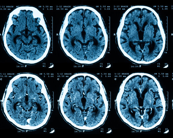 Aufnahme einer Computertomographie des Gehirns: oben ohne und unten mit Kontrastmittel.