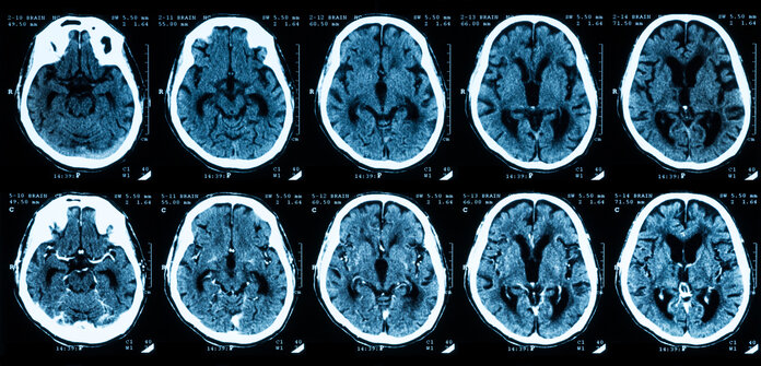 Aufnahme einer Computertomographie des Gehirns: oben ohne und unten mit Kontrastmittel.