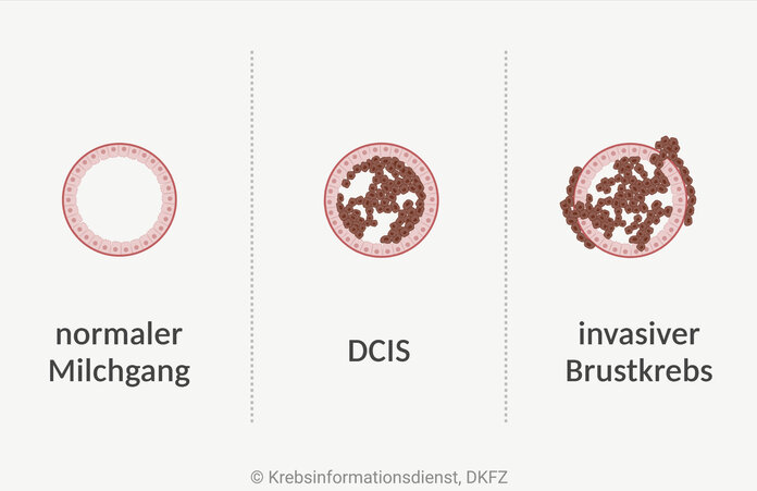 Abgebildet sind Querschnitte eines Milchgangs im Vergleich: normaler Milchgang, DCIS und invasiver Brustkrebs. Bei einem DCIS wachsen die veränderten Zellen nur im Milchgang, bei einem invasiven Brustkrebs durchbrechen sie die Gewebegrenze.