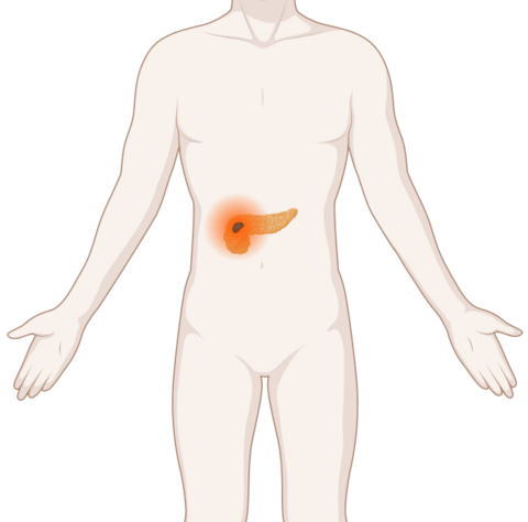 Schematische, anatomische Darstellung einer Bauchspeicheldrüse mit leuchtendem Tumor