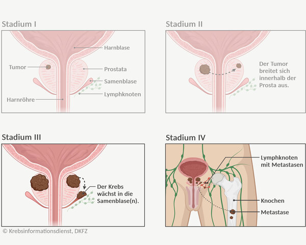 Graphische Darstellung der 4 Tumorstadien bei Prostatakrebs und die unterschiedliche Tumorgröße und Ausbreitung im Körper.