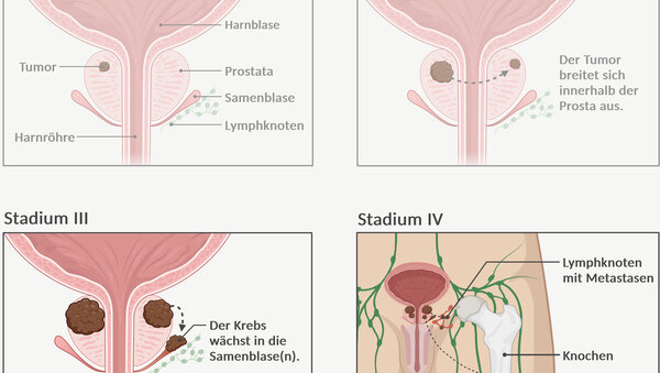 Graphische Darstellung der 4 Tumorstadien bei Prostatakrebs und die unterschiedliche Tumorgröße und Ausbreitung im Körper.