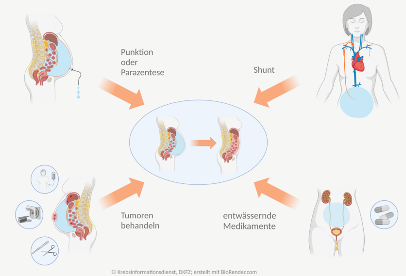 Schematische Übersicht über die Möglichkeiten, die Beschwerden bei einem Aszites zu lindern. Dies ist durch eine Punktion oder Parazentese, einen Shunt, Behandlung der Tumoren oder durch entwässernde Medikamente möglich.