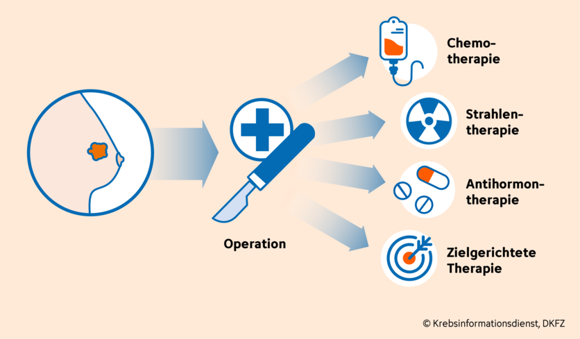 Brustkrebs-Therapien, © Krebsinformationsdienst, DKFZ; Grafik: Anna Diechterow Mindmap der Behandlungsmöglichkeiten bei Brustkrebs: Operation, Strahlentherapie, Chemotherapie, Antihormontherapie, zielgerichtete Therapie.