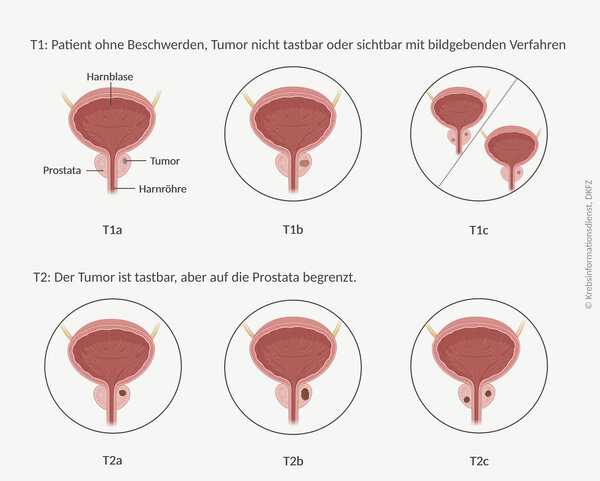 Grafische Darstellung der 6 Tumorstadien bei lokal begrenztem Prostatakrebs.