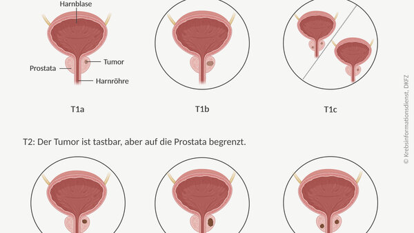 Grafische Darstellung der 6 Tumorstadien bei lokal begrenztem Prostatakrebs.