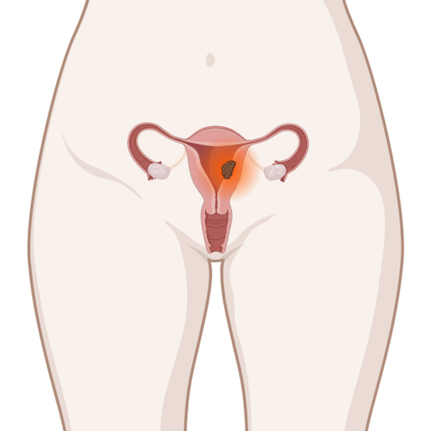 Schematische anatomische Darstellung des Gebärmutterkörpers mit leuchtendem Tumor.