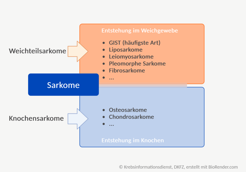 Beispiele für Sarkome, die im Weichgewebe entstehen: GIST (Gastrointestinale Stromatumoren), häufigste Art), Liposarkome, Leiomyosarkome, Pleomorphe Sarkome, Fibrosarkome und weitere. Beispiele für Sarkome, die im Knochen entstehen: Osteosarkome, Chondrosarkome und weitere.