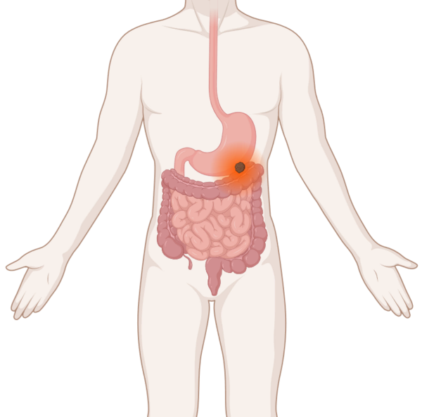 Gastrointestinaler Stromatumor, © Krebsinformationsdienst, DKFZ; erstellt mit BioRender.com Schematische Darstellung der Verdauungsorgane mit leuchtendem Tumor im Magen.