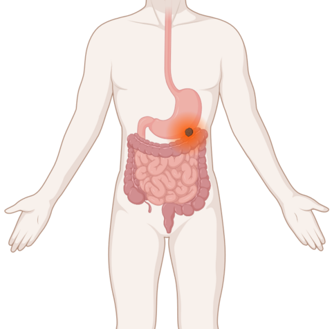 Schematische Darstellung der Verdauungsorgane mit leuchtendem Tumor im Magen.