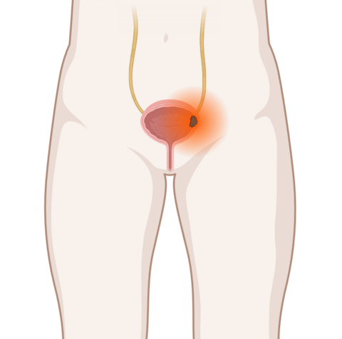 Blasenkrebs, © Krebsinformationsdienst, DKFZ; erstellt mit Biorender.com Schematische anatomische Darstellung der Harnblase mit leuchtendem Tumor