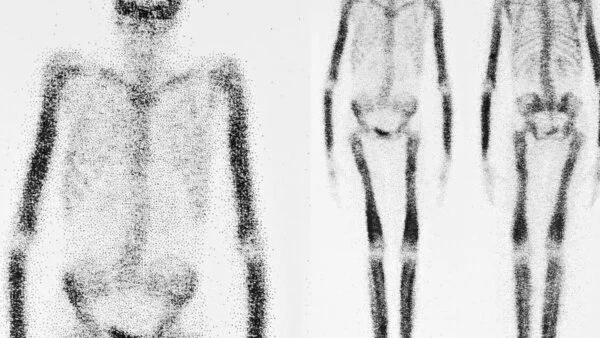 Skelettszintigramm, © Susan Law Cain, iStock Schwarz-weiße, schemenhafte Darstellung eines Skeletts