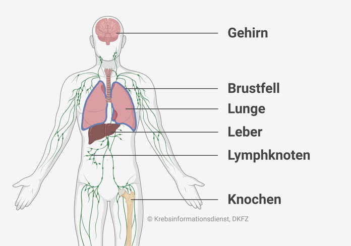 Anatomische Abbildung, die zeigt wo sich beim CUP-Syndrom häufig Metastasen bilden: im Gehirn, Brustfell, Lunge, Leber, Lymphknoten und Knochen.