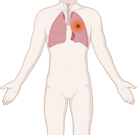 Schematische, anatomische Darstellung einer Lunge mit leuchtendem Tumor