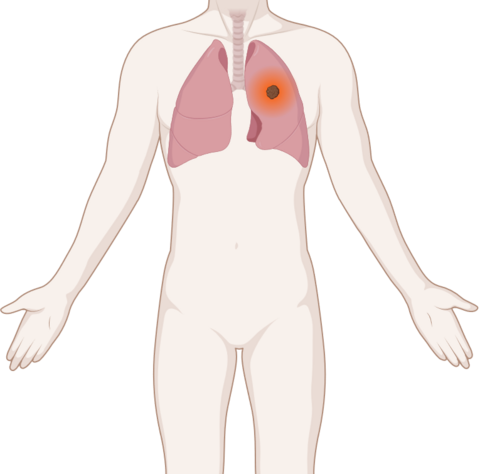 Schematische, anatomische Darstellung einer Lunge mit leuchtendem Tumor