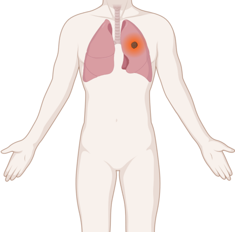 Schematische, anatomische Darstellung einer Lunge mit leuchtendem Tumor