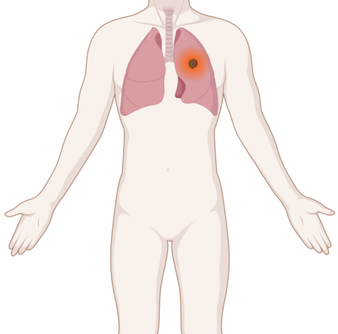 Schematische, anatomische Darstellung einer Lunge mit leuchtendem Tumor