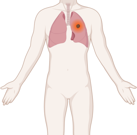 Schematische, anatomische Darstellung einer Lunge mit leuchtendem Tumor